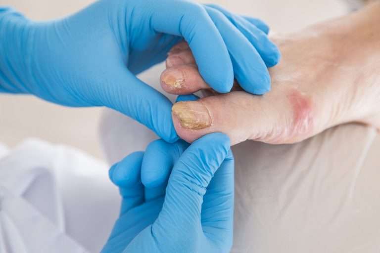 Image de :Nail fungus (Onychomycosis)