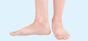 Image de :Flat foot or cavus foot: which one do you have?