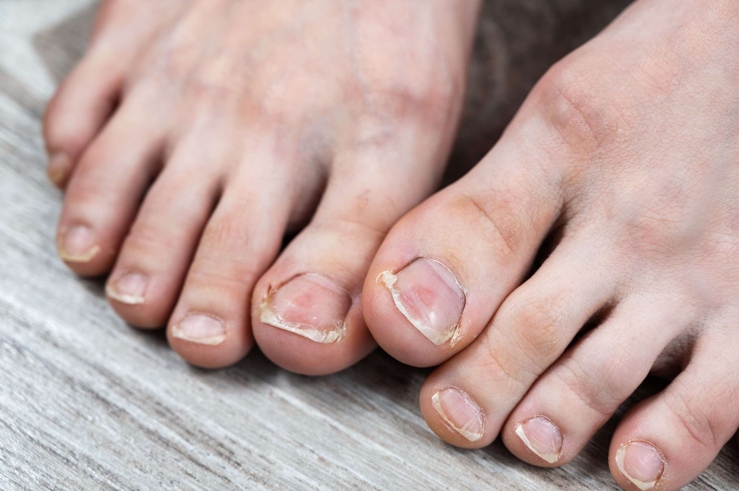 Image de :How to prevent and treat ingrown toenails?