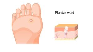 Image de :How do I treat my plantar warts at home?