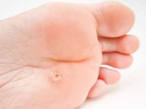 Image de :Common and plantar warts